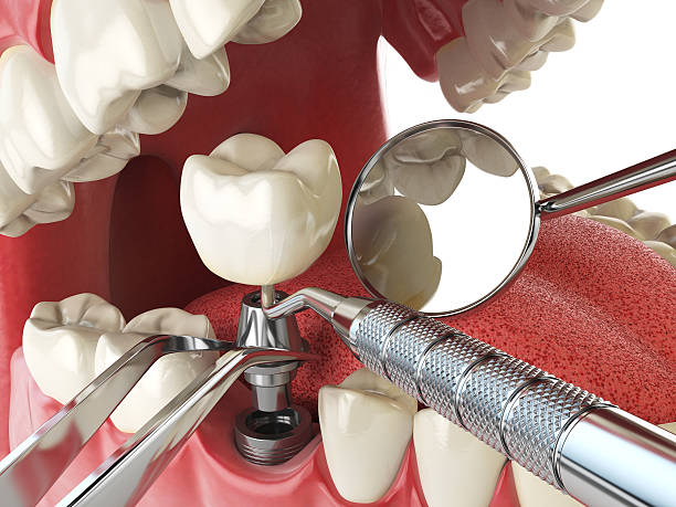 Best Emergency Tooth Extraction in Key West, FL